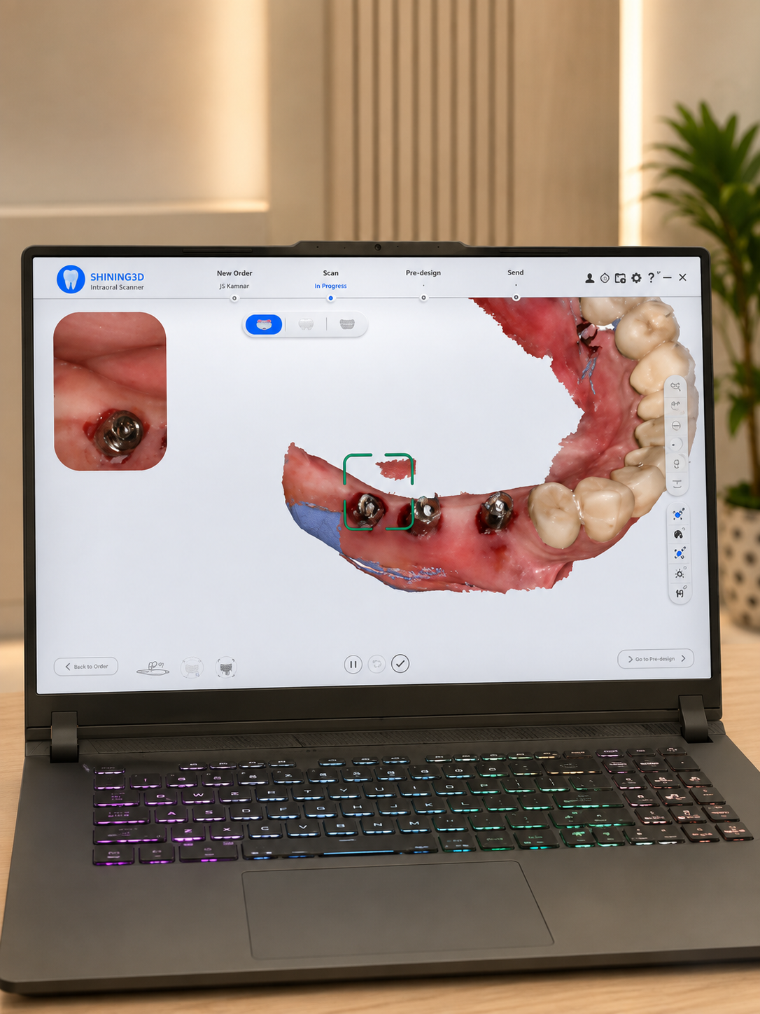 Intraoral scanner software showing a live 3D implant scan on screen