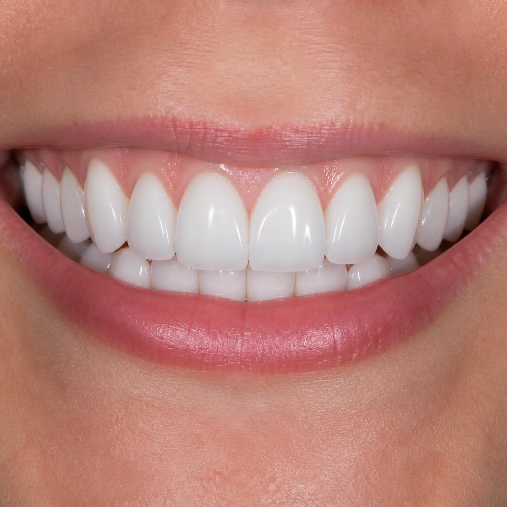 Bright, evenly aligned smile after cosmetic dental treatment at Nirvighnam Dental