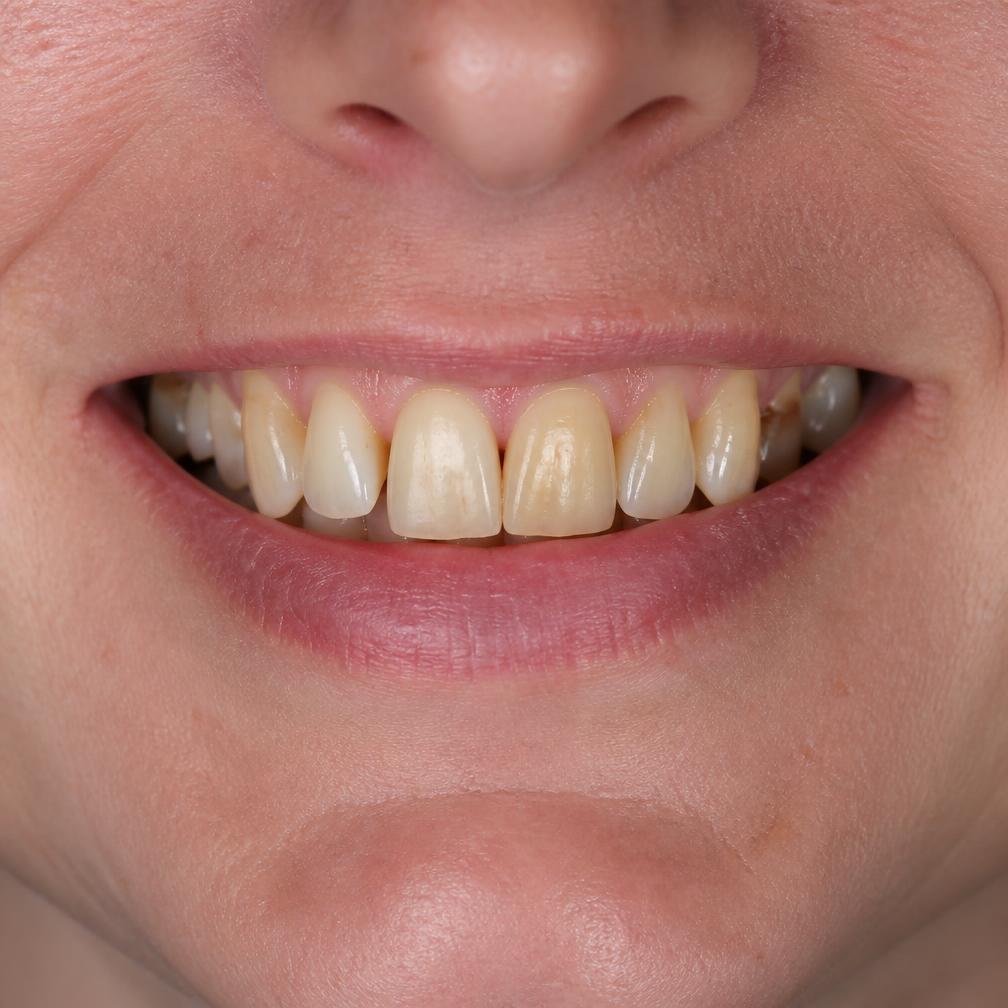Discoloured and uneven natural smile before cosmetic dental treatment
